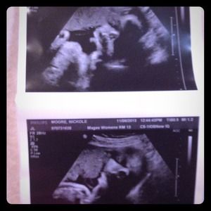 MY beautiful baby girl at 32weeks and 4 days