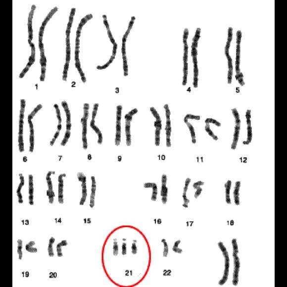 👧🏻 About Down Syndrome - Picture 3 of 3