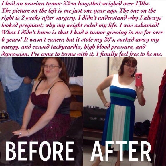 Test Your Breasts and Ovaries! - Picture 2 of 13