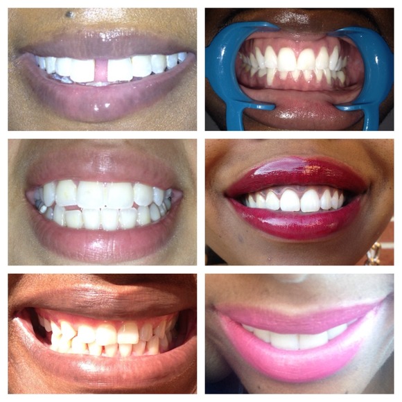 Teeth whitening kits - Picture 1 of 4