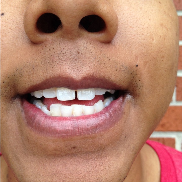 Teeth whitening kit - Picture 3 of 4