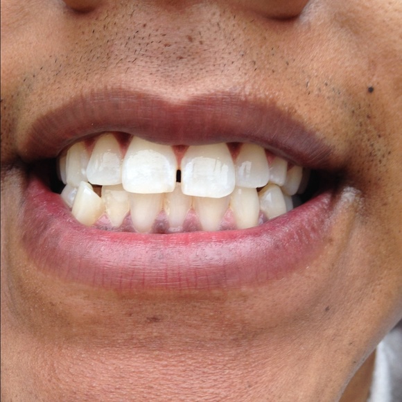 Teeth whitening kit - Picture 4 of 4