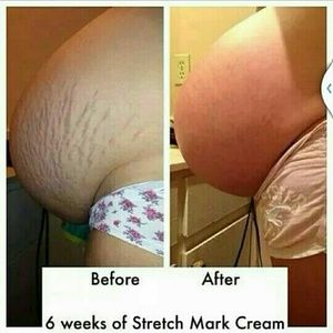 Stretch mark cream 20 grams