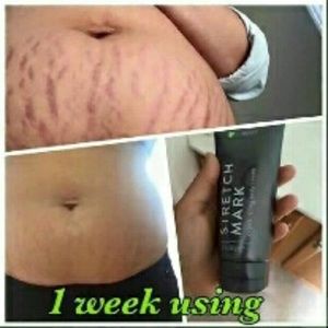 Stretch Mark Reduction Cream