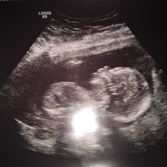 IM CURRENTLY PREGNANT 33 WEEKS AND 4 DAYS💙 - Picture 1 of 4