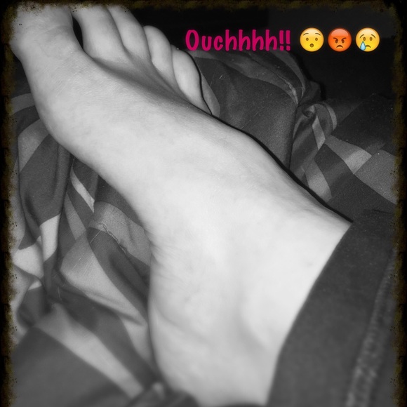 Broken foot 😕