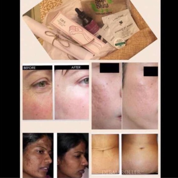 Brand new Derma roller set