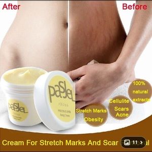 Scar & stretch marks removal cream