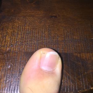 Hairy big toe