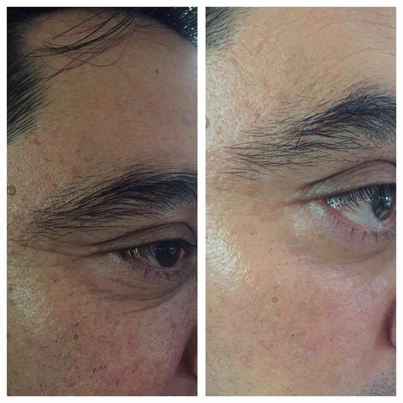 Juventud Botox Like The Alternative to Injections