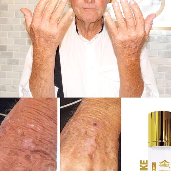 Juventud Botox Like The Alternative to Injections