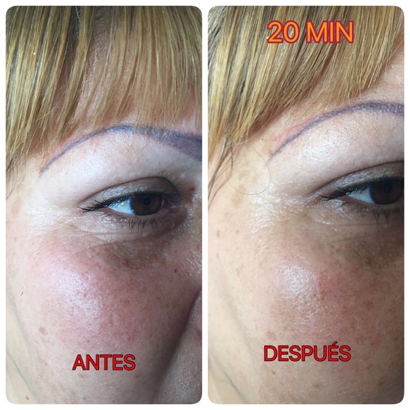 Juventud Botox Like The Alternative to Injections