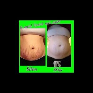 Stretch mark cream
