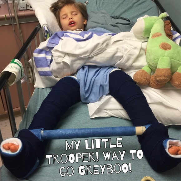 CASTS R OFF!!! #TeamGreyBoo #StopCMV #cpawareness - Picture 4 of 4