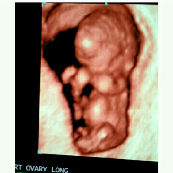 1 Yrs Old NOW Had Him @36 Weeks 🆕Pictures - Picture 2 of 8