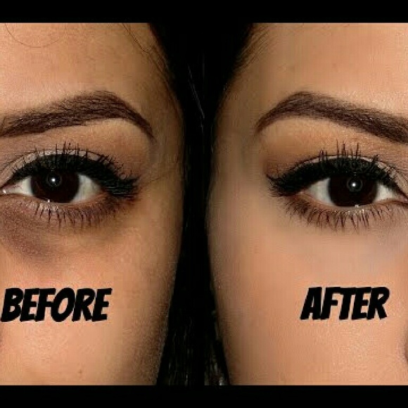 Other Flash Sale Severe Dark Circle Eye Remover Poshmark