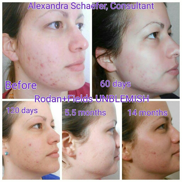 Rodan+Fields Unblemish for acne/acne scars - Picture 2 of 4