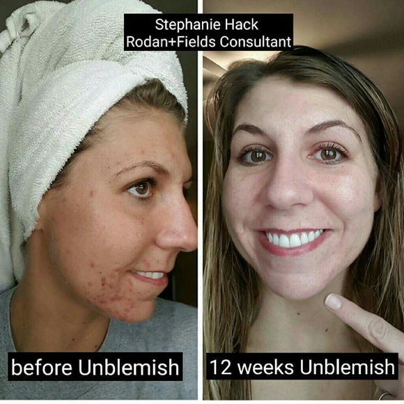 Rodan+Fields Unblemish for acne/acne scars - Picture 3 of 4