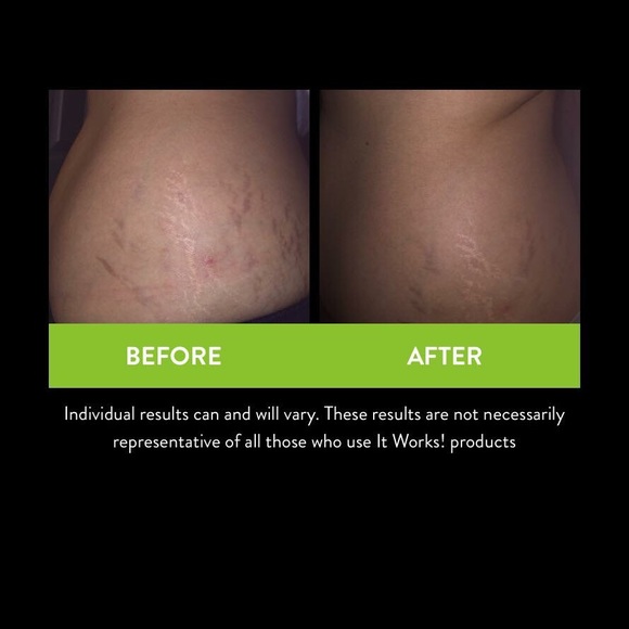 Itworks Stretch Mark Cream - Picture 2 of 2