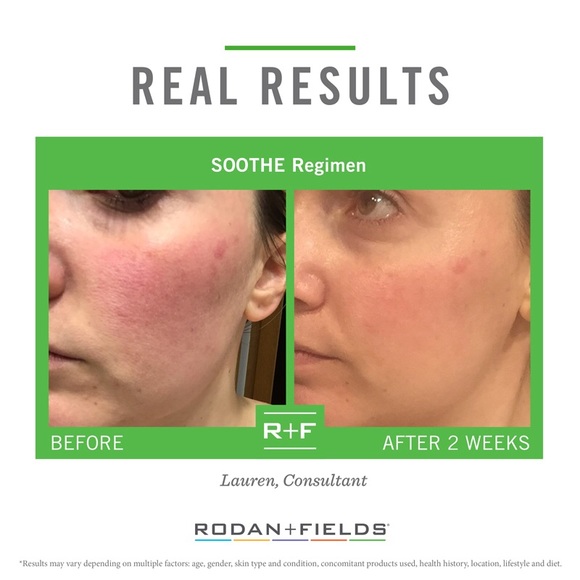 Rodan + Fields Soothe - Picture 2 of 4
