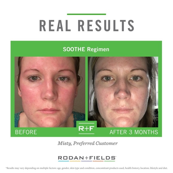 Rodan + Fields Soothe - Picture 4 of 4