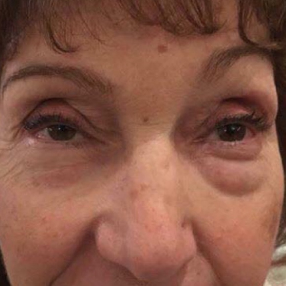 Hydrogel EyeV Patches. No more puffy wrinkled eyes
