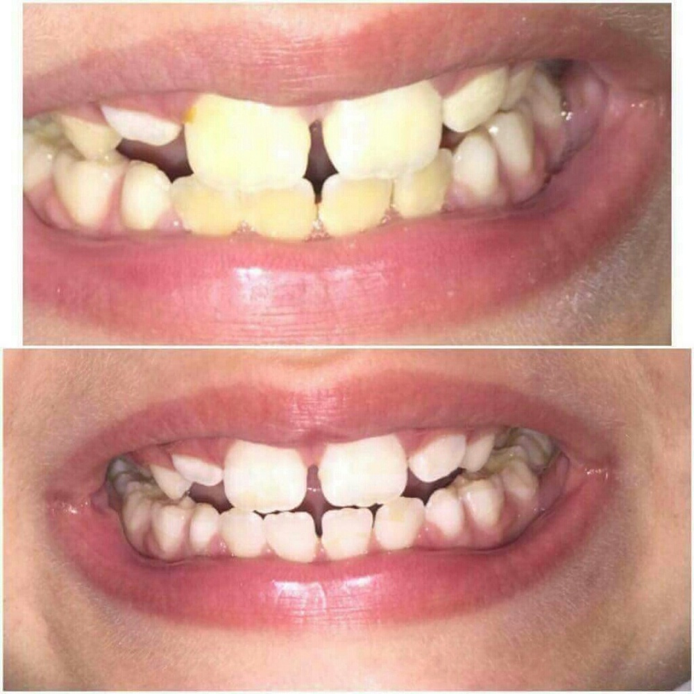 💎Professional AP24 Whitening Toothpaste💎 - Picture 2 of 4