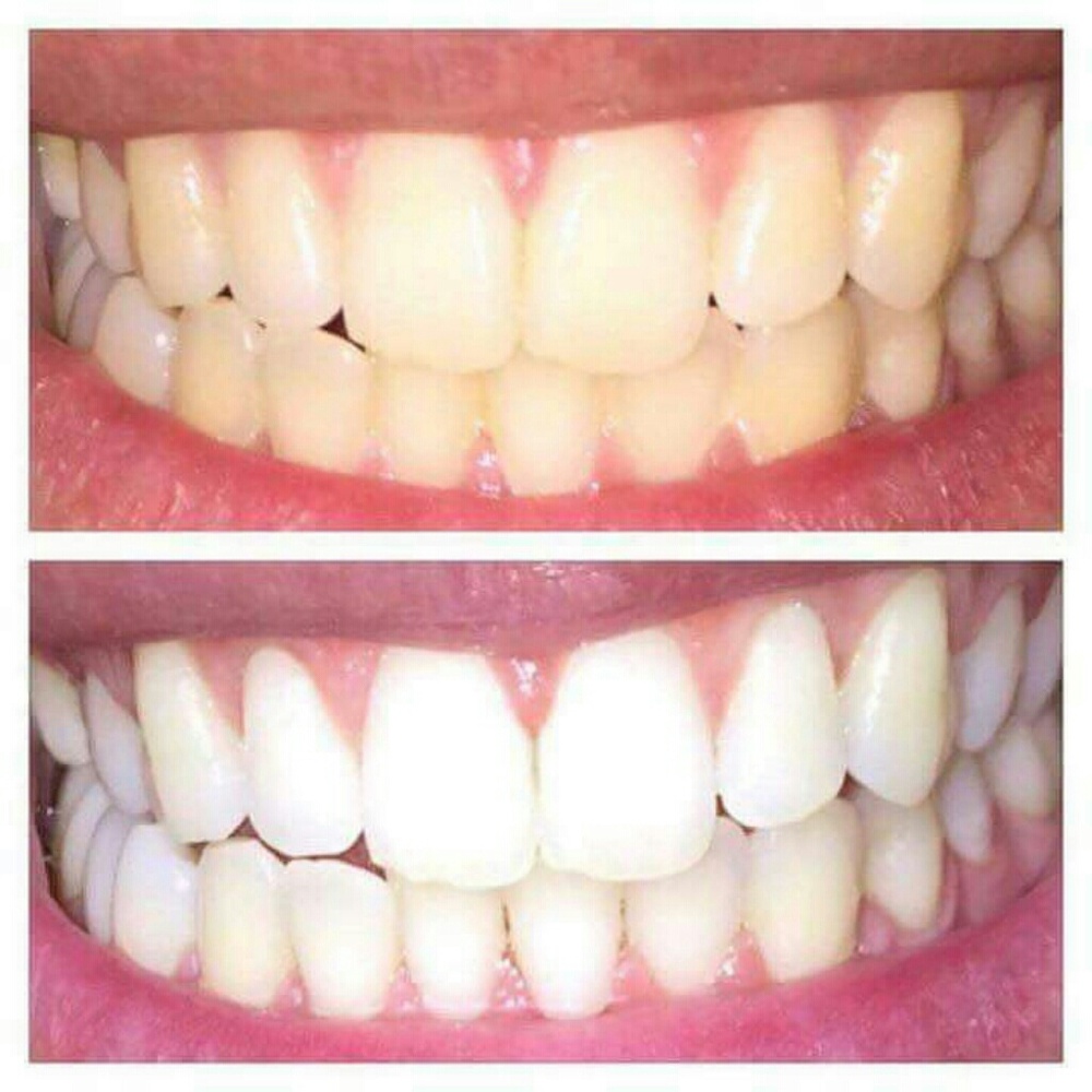 💎Professional AP24 Whitening Toothpaste💎 - Picture 3 of 4