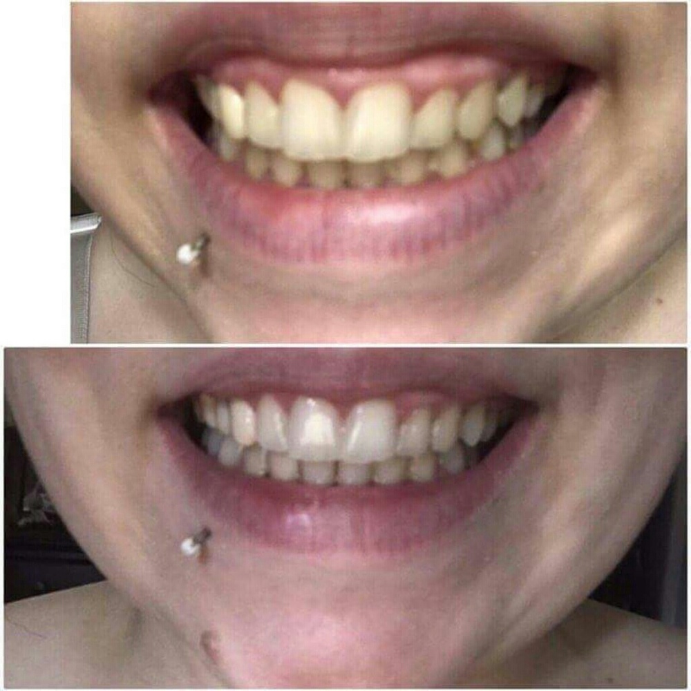 💎Professional AP24 Whitening Toothpaste💎 - Picture 4 of 4
