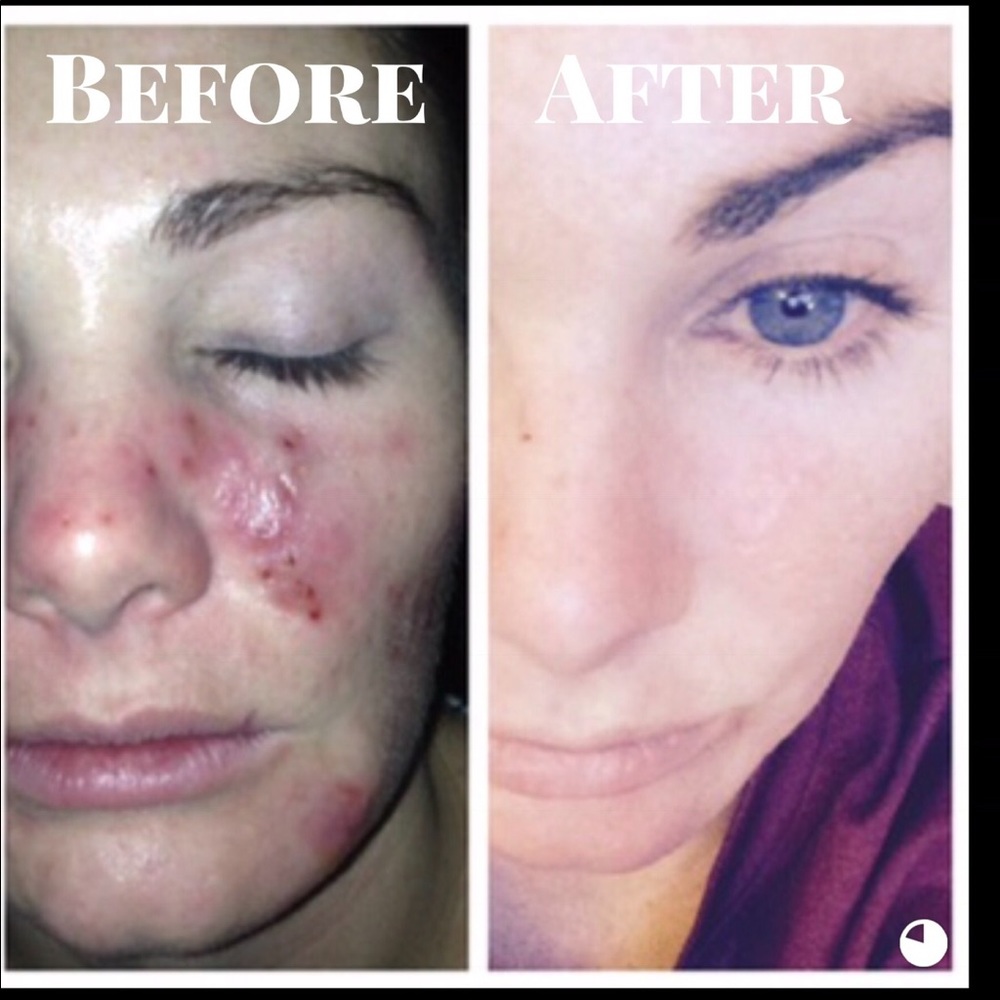 Acne  SERUM✨✨✨✨ - Picture 2 of 2