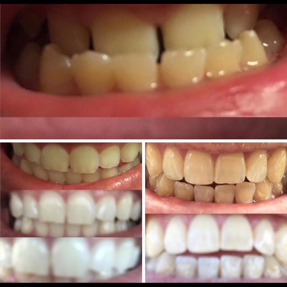 No more yellow or stained teeth!
