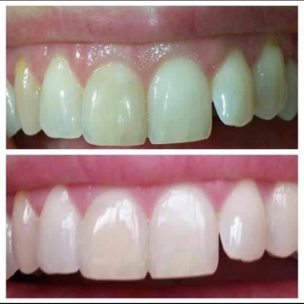 *Whitening Toothpaste 💋❤️💋 - Picture 2 of 5