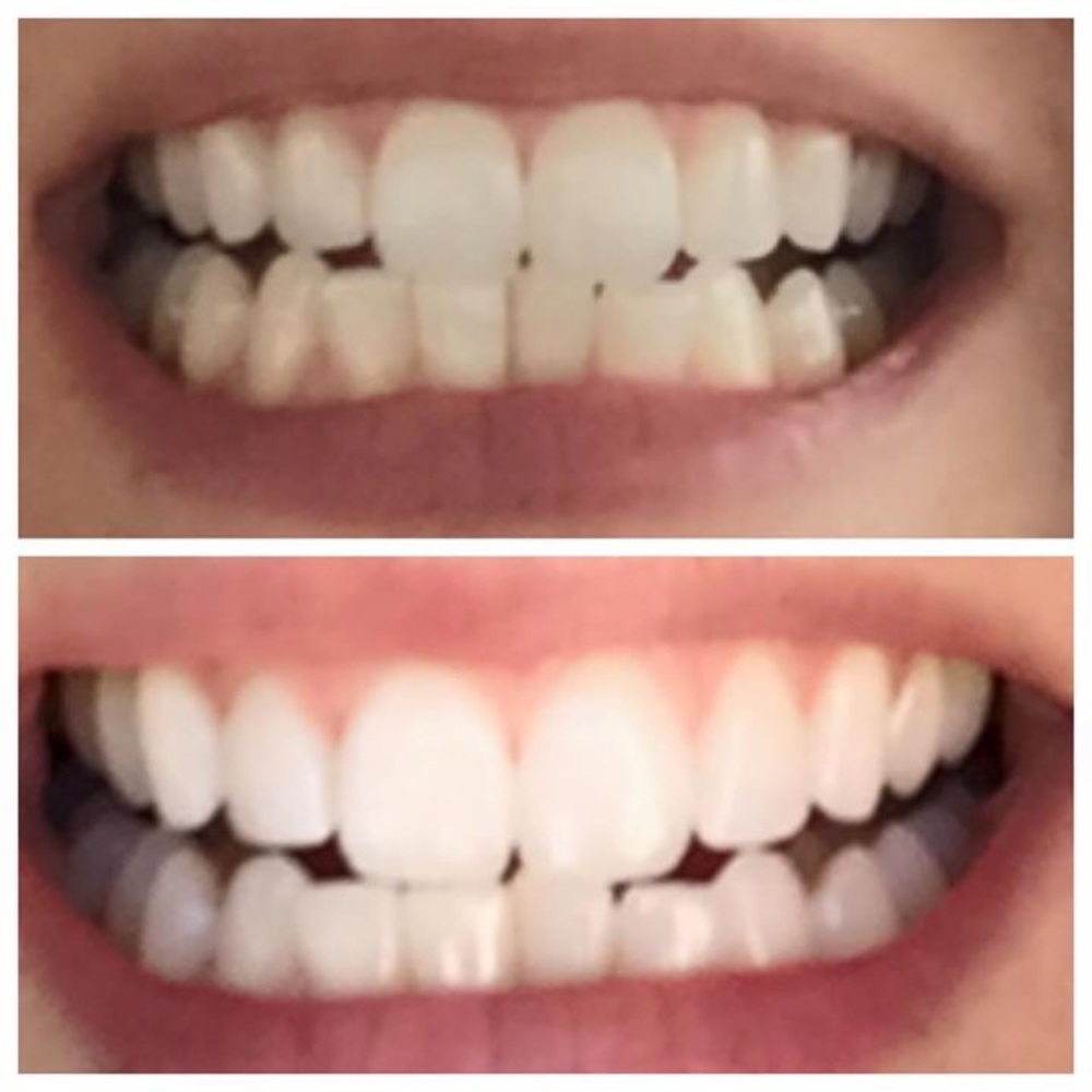 *Whitening Toothpaste 💋❤️💋 - Picture 3 of 5