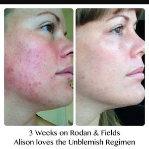 Unblemish regimen Rodan + Fields