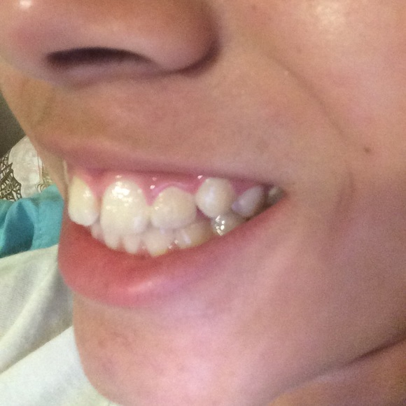 False teeth - Picture 2 of 4