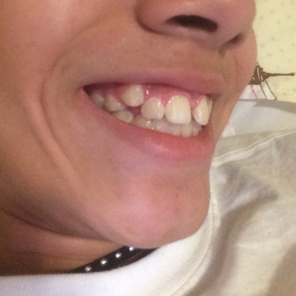 False teeth - Picture 3 of 4