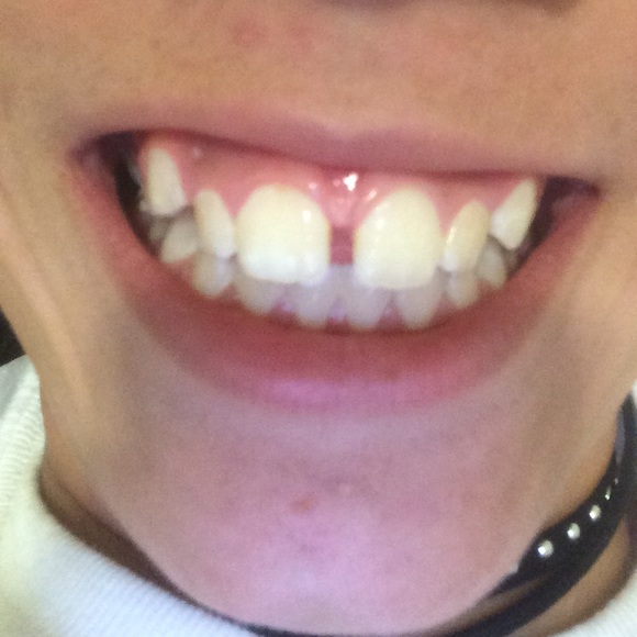 False teeth - Picture 4 of 4