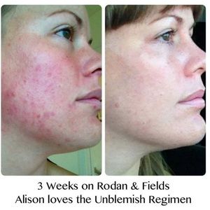Rodan + Fields unblemish regimen