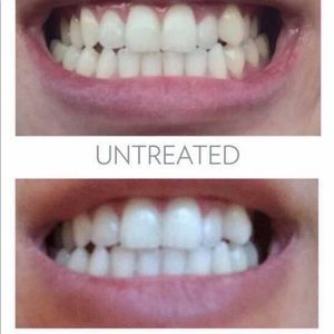 Whitening toothpaste