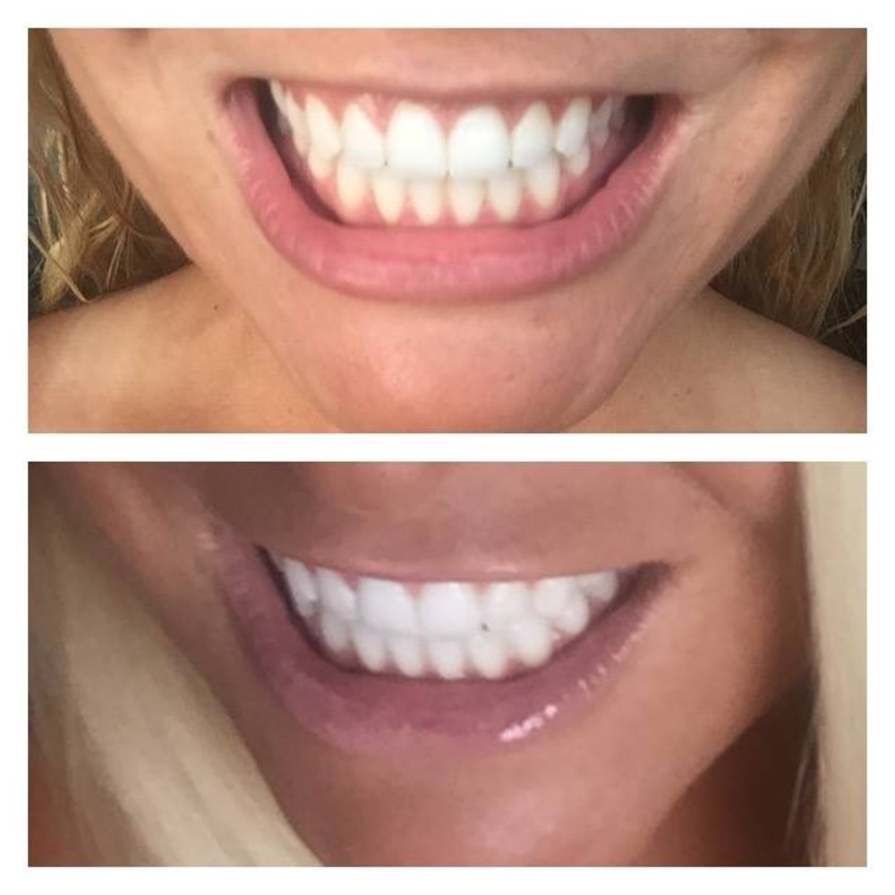 BEST WHITENING TOOTHPASTE EVER!