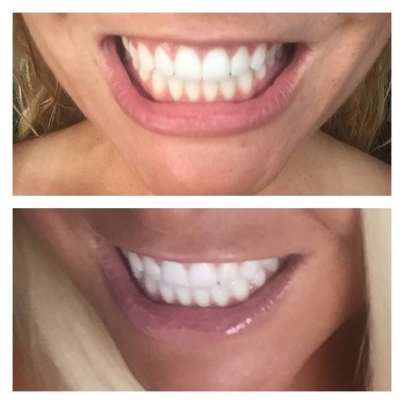 Best Whitening Toothpaste >> Other Best Whitening Toothpaste Ever Poshmark Best Whitening Toothpaste >> Other Best Whitening Toothpaste Ever Poshmark