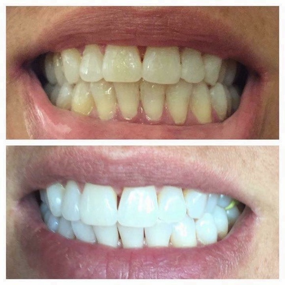 Whitening Toothpaste - Picture 2 of 2
