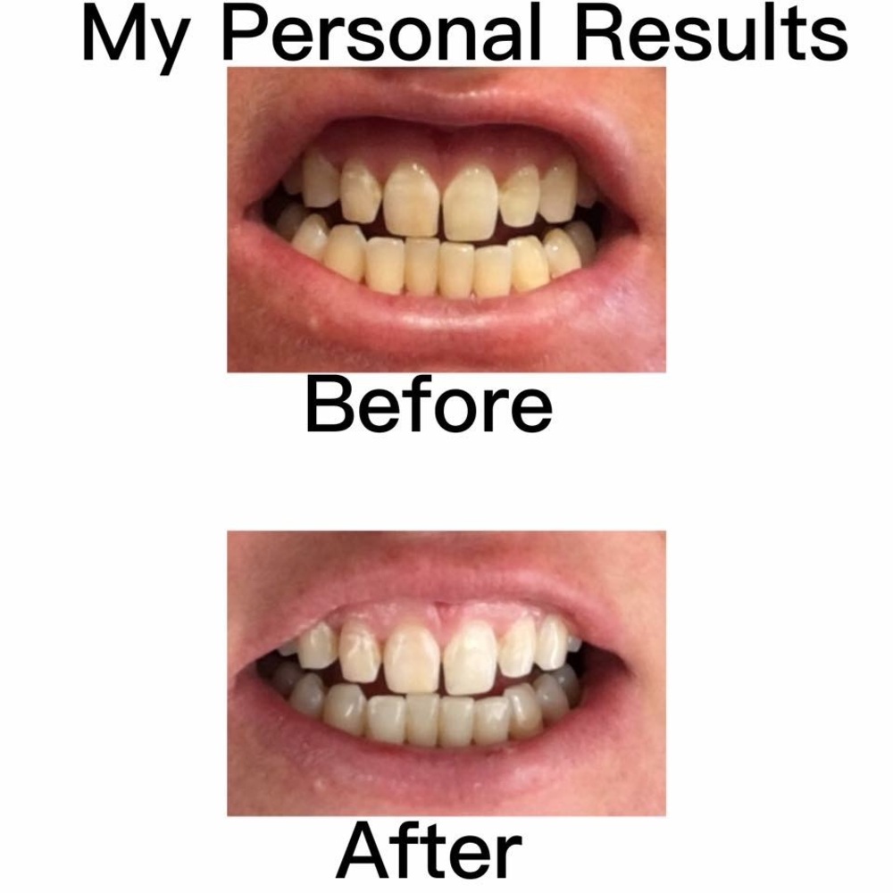 Want whiter teeth