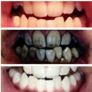 Teeth whitening organic charcoal