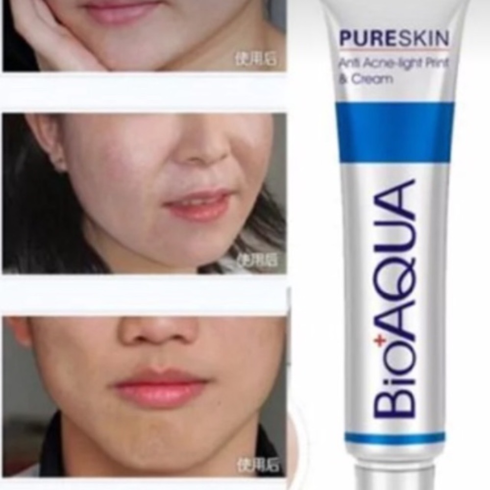 Acne Scar cream!    Large tube!   New tube!