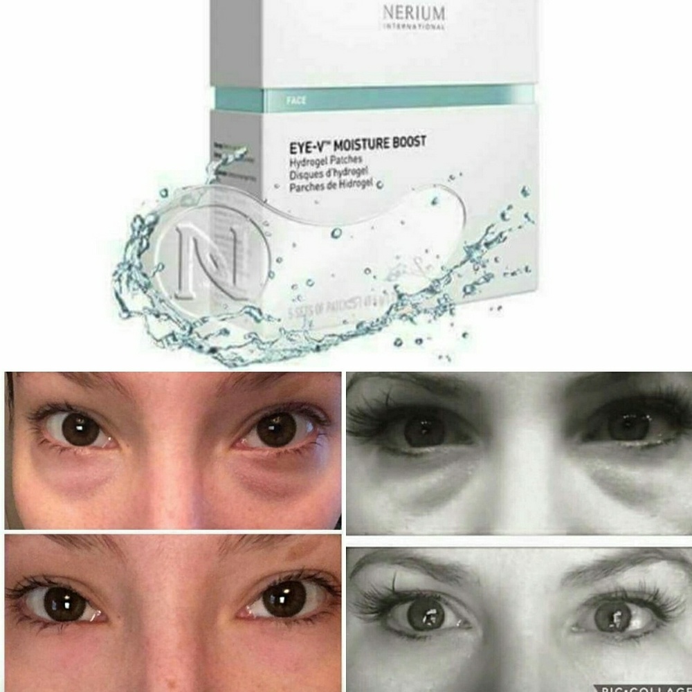 Eye-V Hydrogel Patches