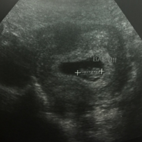 We're Pregnant! 🤰🏼👶🏼😍 - Picture 3 of 6