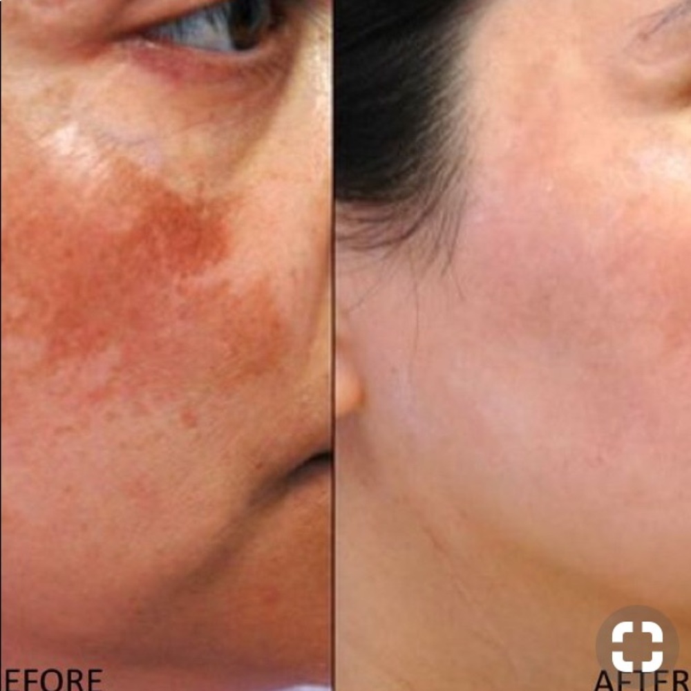 Skin care