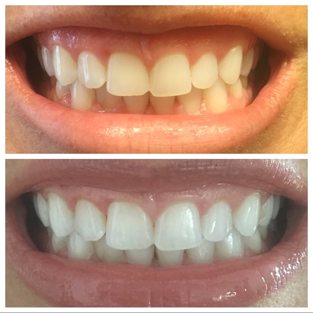 Whitening Toothpaste
